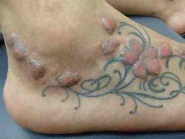 tattoo, infected tattoo, ink